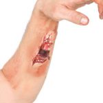 Fracture
