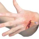 Pencil Stab Prosthectic